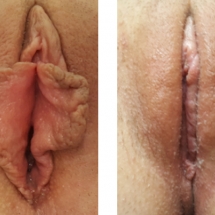 LABIAPLASTY/age 20/6 wks postop