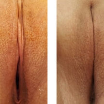 VAGINOPLASTY/age 24/6 wks postop
