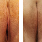 AGE 25-VAGINAL REJUVENATION
