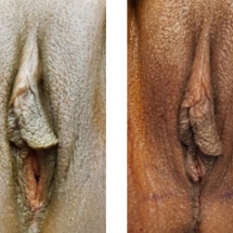 2P2-VAGINOPLASTY/age 29/immediate postop