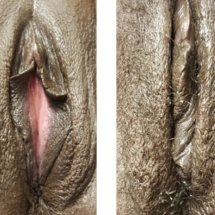 VAGINOPLASTY/age 40/4 wks postop