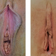 VAGINOPLASTY/age 40/6 wks postop