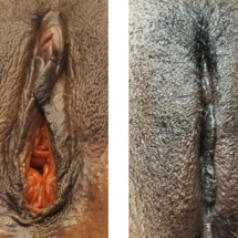 VAGINOPLASTY/age 40/8 wks postop