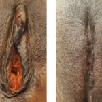 AGE 41-VAGINAL REJUVENATION