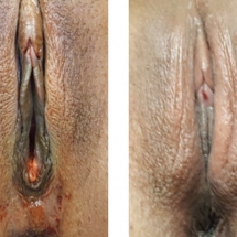 VAGINOPLASTY/age 42/5 wks postop
