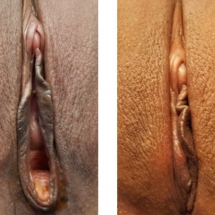 VAGINOPLASTY/age 43/immediate postop