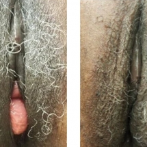 VAGINOPLASTY & ENTEROCELE REPAIR/age 60/6 wks postop