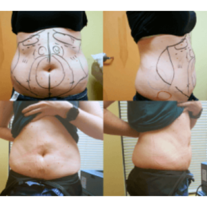 A Patient’s Liposuction Story