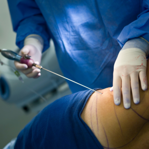 What is the Purpose of Liposuction?